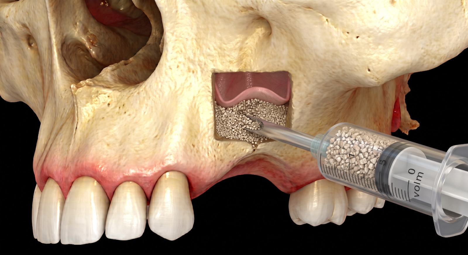 Step 2: bone graft material being injected into the sinus cavity with a syringe